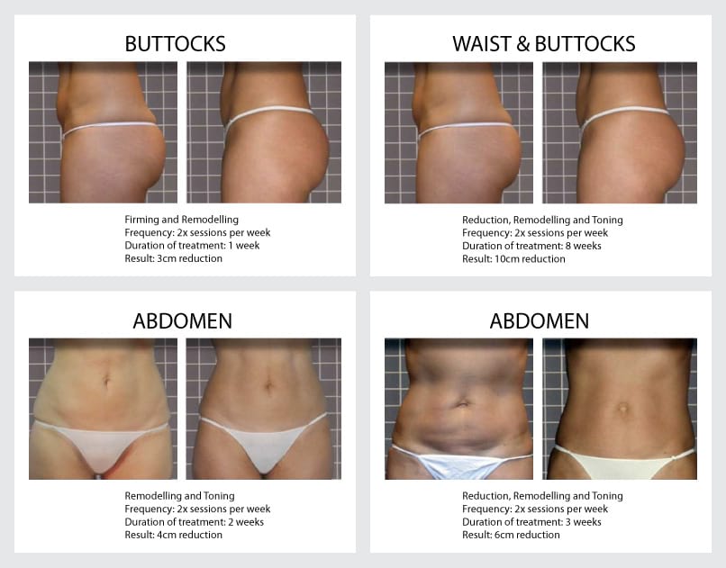 Body Shaping Treatments  Non Surgical Body Shaping & Sculpting